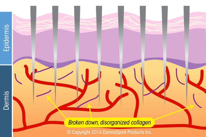 Microneedling Niagara