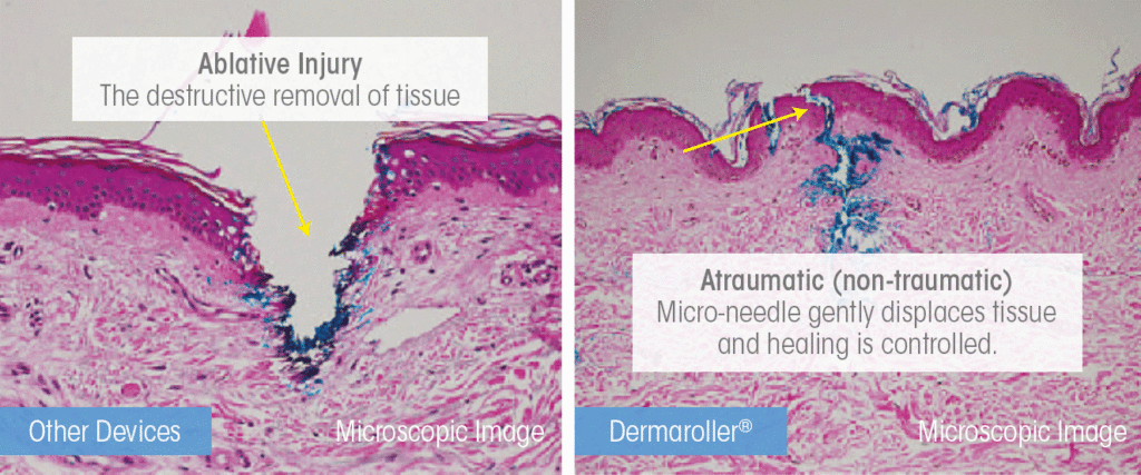 Micro-needling Niagara